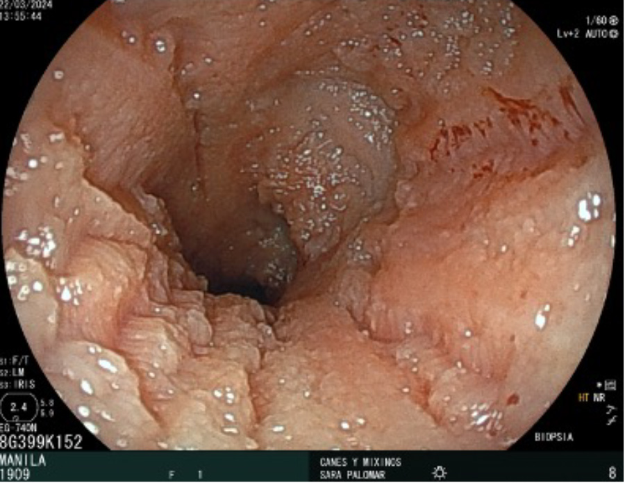 El IBD es una enfermedad que se caracteriza por la presencia de signos gastrointestinales crónicos y cuya causa es indeterminada. Para llegar al diagnóstico definitivo es imprescindible la toma de muestras obtenidas por biopsia, por lo que le realizamos una endoscopia digestiva.