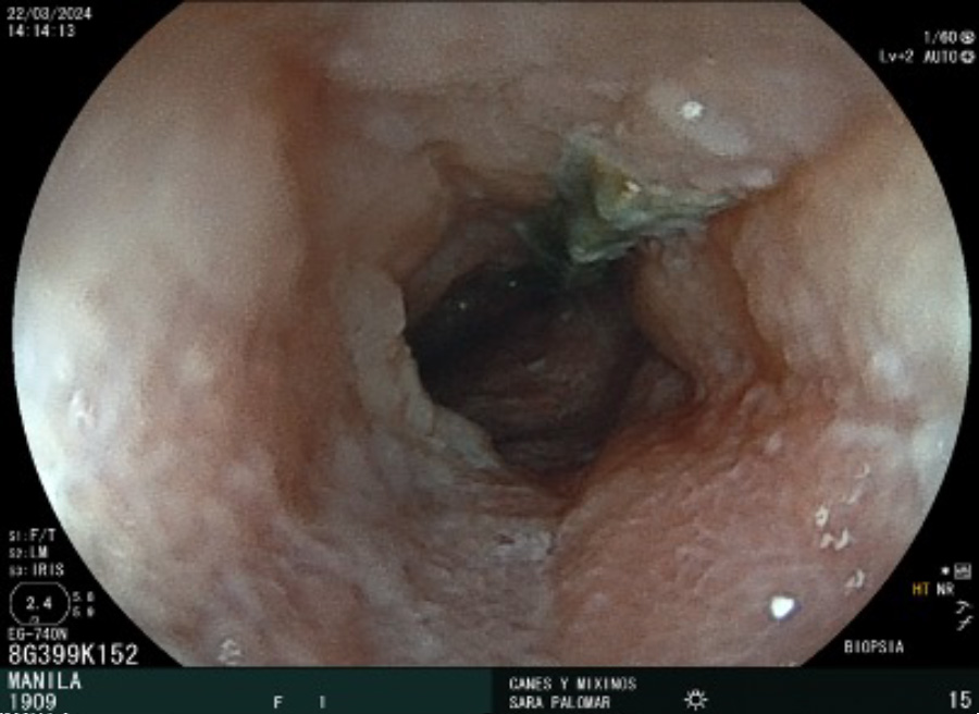 Al realizar una ecografía abdominal, se vieron hallazgos que nos hicieron sospechar de enfermedad inflamatoria intestinal crónica (IBD).