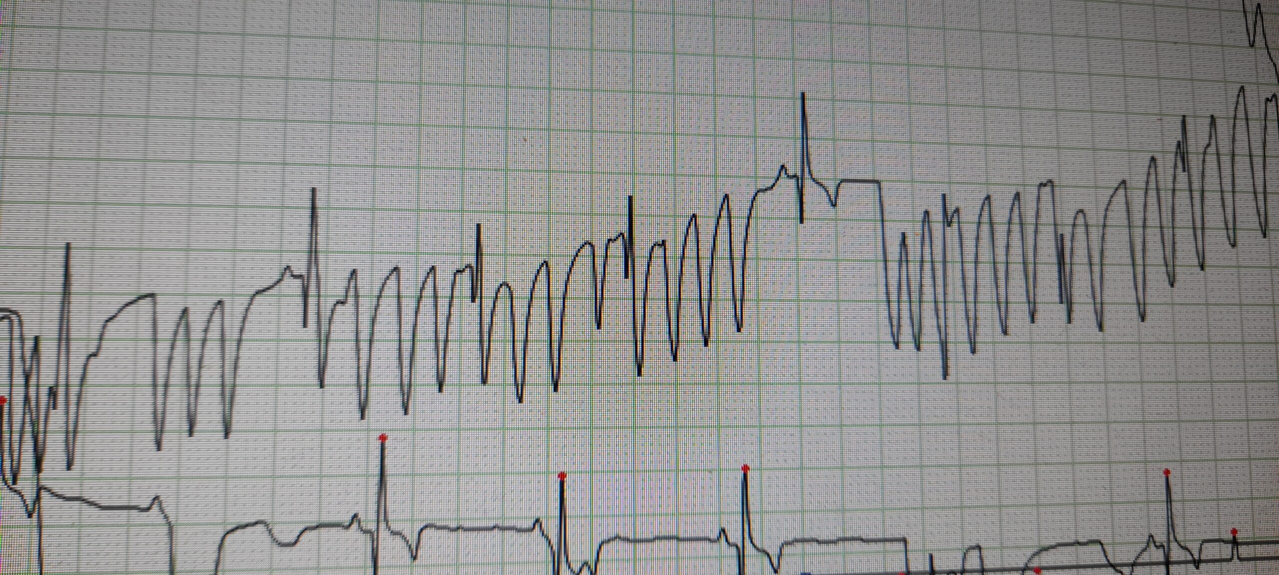 Como no nos quedamos tranquilas decidimos realizar un Holter ( estudio del ritmo cardíaco avanzado) y pudimos diagnosticar una taquicardia ventricular paroxística ( arritmia grave).